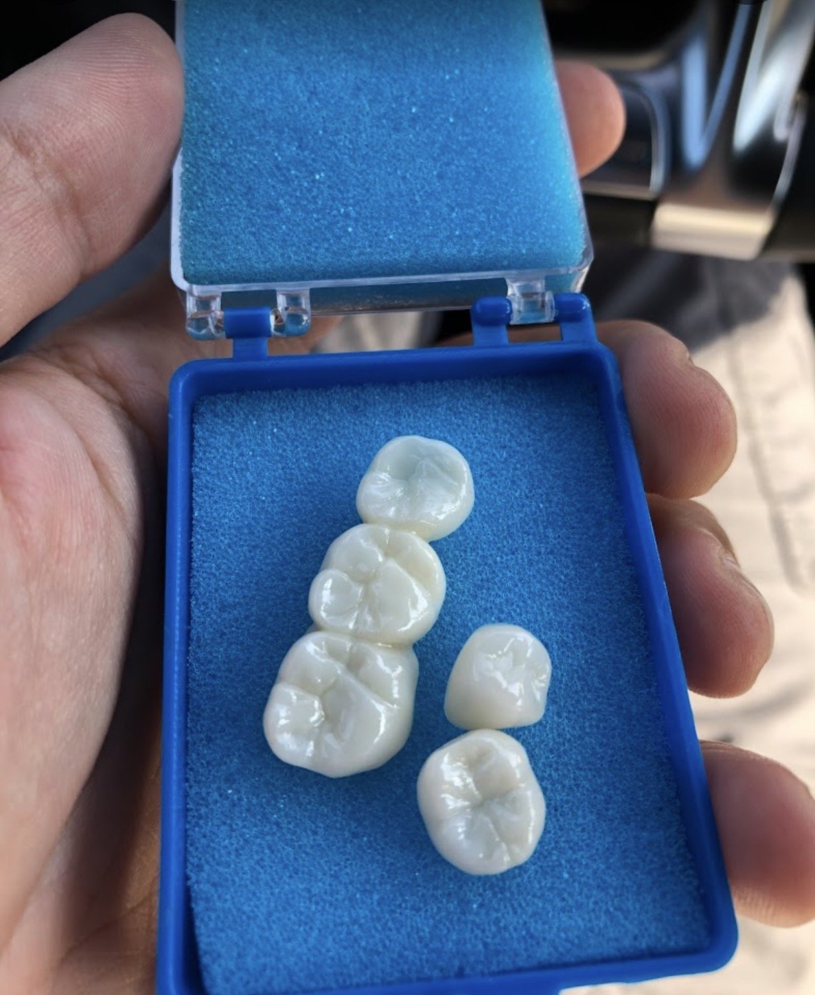 Finished dental crowns ready for placement